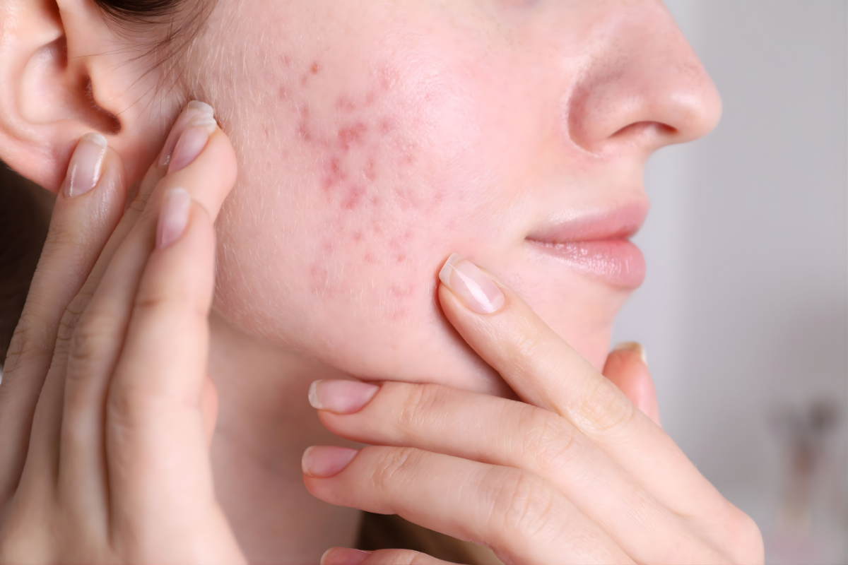Acne, Pimples & Scar Treatment